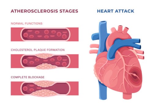 heart attack concept. unhealthy heart. heart with atherosclerotic plaque. - junk food stock illustrations